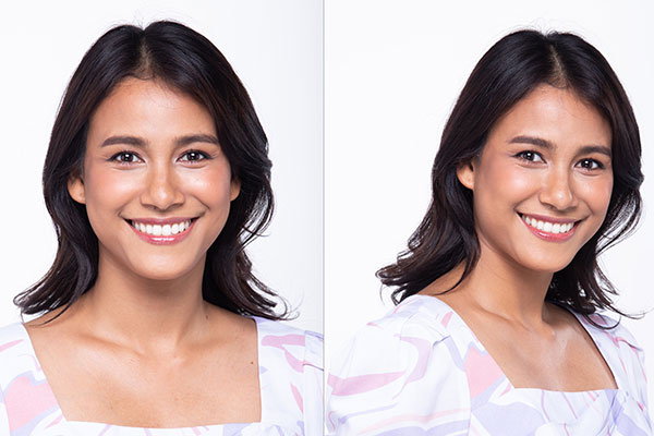 Gummy Smile Correction