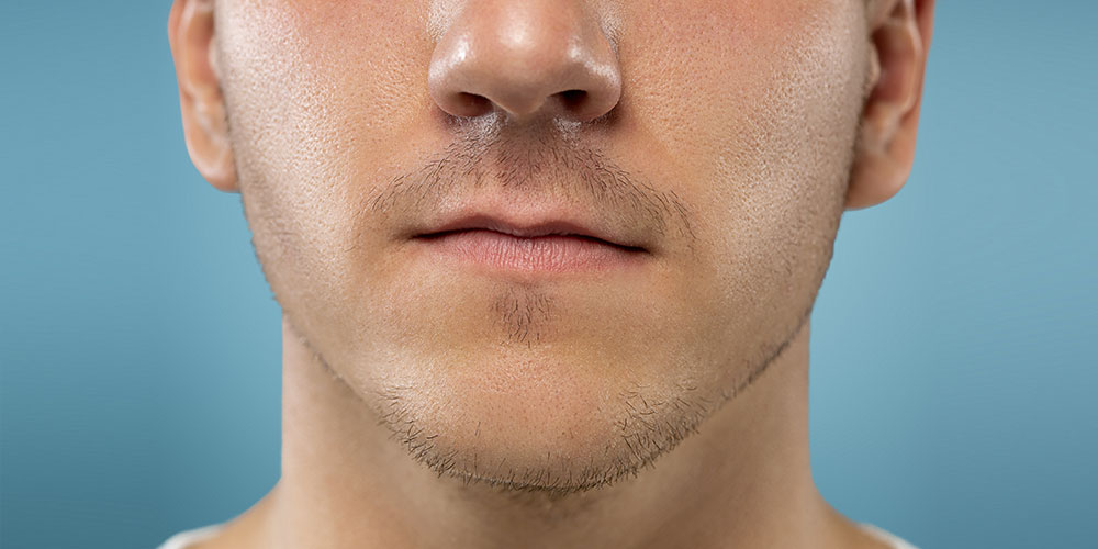 Adult Cleft Lip & Palate Surgery